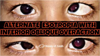 SquintStrabismus Examination  Alternate Esotropia With Inferior Oblique Overaction [upl. by Kennie]