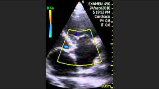 VSCAN Tricuspid insufficiency Pocket Ultrasound [upl. by Sproul]