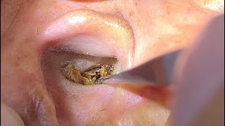 Removes earwax and wax debris inside the ear 耳垢や耳の中の耳垢の破片を除去します earwaxremoval earwaxcleaner [upl. by Inavoig672]