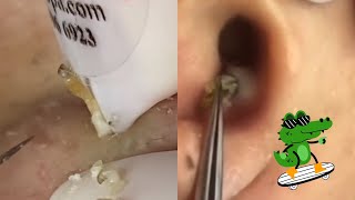 Ultimate ASMR Pimple Popping Compilation  Blackhead amp Cyst Extraction for Maximum Relaxation [upl. by Siulesoj]