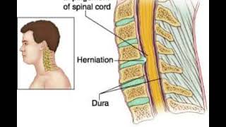 cervical Myelopathyneckpain cervicalpain backpain motivation kuchamancity 1k didwana [upl. by Yecaw900]