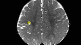 Perinatal hypoxic injuty with white matter paucity and gliosis Ulegyria [upl. by Gunter567]