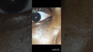 popping stye  squeezing puss out of eye pimplepop pimplepopping stye blackheadremoval [upl. by Irabaj]