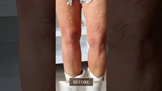 Legs Fascia blasting For Soft and Smooth Skin Before And After [upl. by Sapphira]