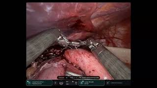 Robotic Toupet Fundoplication Technique [upl. by Ennaxxor]