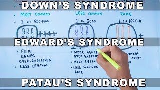 Trisomy  Downs vs Edwards vs Pataus Syndrome [upl. by Giesser]