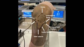 In Office Needle Arthroscopy of the Knee With Lateral Parapatellar Retinacular Release [upl. by Leizahaj]