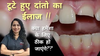 टूटे हुए दांतो का ईलाज fractured teeth treatment dental dentaltreatment [upl. by Loginov]