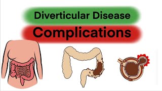 Complications of Diverticular Disease [upl. by Aneelad615]