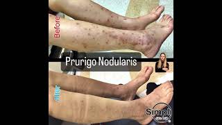 Prurigo Nodularis [upl. by Franck217]