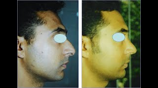 جراحة التجميل المغرب  جراحة الأنف  Chirurgie esthétique Maroc  Rhinoplastie  Rhinoplasty [upl. by Adrian]