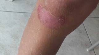 A case of Impetigo on a 8 year old Dutch boy [upl. by Ettelrats]