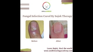 Fungal Infection of Nail Cured By Sujok Therapy [upl. by Musser815]