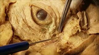 Palpebral and Lacrimal Apparatus Dissection – Clinical Demonstration – Sanjoy Sanyal [upl. by Haslam206]