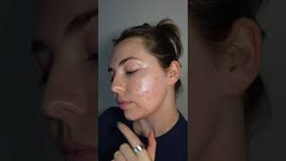 postacne skincare routine with LED red light therapy [upl. by Nethsa]