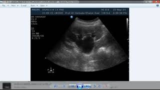 Record 2024 09 23 14 22 43 261 Prof Dr Hamada Khater BEST ULTRASOUND AND DOPPLER CASES [upl. by Catt]