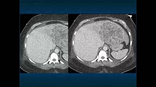 CT Evaluation of Liver Masses Key Differential Diagnosis Pathways  Part 4 [upl. by Oshinski]