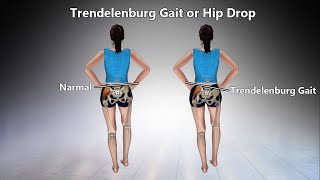 Trendelenburg Gait  Definition Causes Characteristics Diagnosis Treatment [upl. by Terrijo]