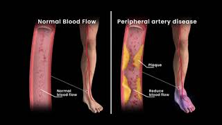 Peripheral Artery Disease Angioplasty [upl. by Semadar]