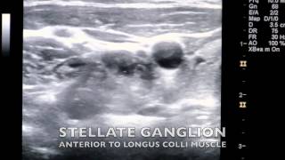 Ultrasound Guided Stellate Ganglion Block [upl. by Airdnaid945]