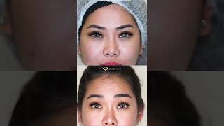 Botox Allergan allergan botulinumtoxin botox antiwrinkle antiagingtreatment skinevo [upl. by Laverne367]