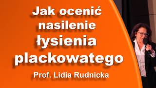 Łysienie plackowate Jak ocenić ciężkość choroby [upl. by Eekorehc]