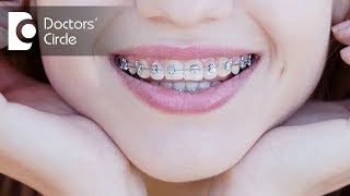 How to close the gap between upper amp lower front teeth  Dr Aniruddha KB [upl. by Nnayram543]