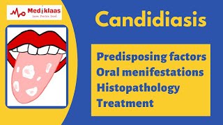 Candidiasis l Oral thrush l Oral pathology l Mediklaas [upl. by Robyn]