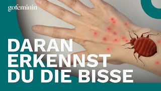 Bettwanzen Daran erkennst du die Bisse [upl. by Nagap]