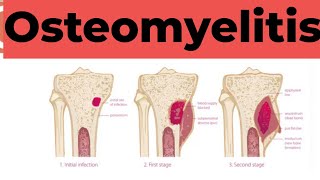 Osteomyelitis  Causes Sign and Symptoms Diagnosis amp Treatment Pathology [upl. by Annol]