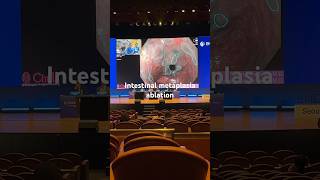 Intestinal metaplasia ablation ENDO2024 [upl. by Lockwood672]