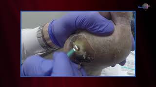 WCW Managing Diabetic Foot Ulcers  Debridement and Classifying Ulcers [upl. by Ronn]