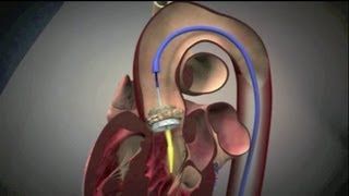 Transcatheter Aortic Valve Implantation TAVI [upl. by Aicelef]