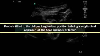 Ultrasound guided hip joint injection [upl. by Nauwaj646]