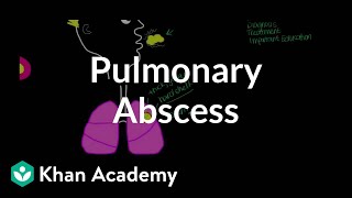 Pulmonary abscess  Respiratory system diseases  NCLEXRN  Khan Academy [upl. by Inoek]