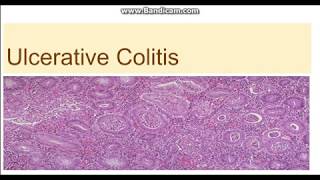 Ulcerative colitis  Morphology Clinical features difference from Crohn disease [upl. by Ahsieyt68]