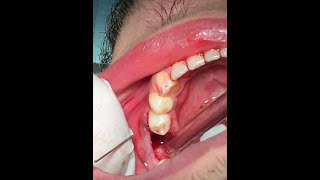 How to pull a broken tooth  First Molar extraction  قلع جراحي [upl. by Etnauj49]