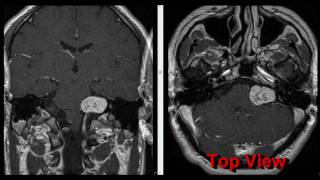 Acoustic Neuroma MRI and pics [upl. by Dearborn275]