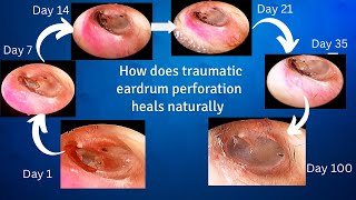 How does traumatic eardrum perforation heals [upl. by Alyss559]