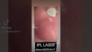 IPL Laser before and after rosacea [upl. by Annail]