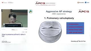 How to preserve pulmonic valve in TOF [upl. by Kaden]