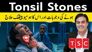 Homeopathic Medicines for Tonsillitis  tonsils homeopathic medicine  Adeel mansoor [upl. by Leinoto739]