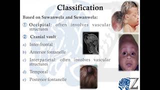 Encephalocele كيس الدماغ [upl. by Adiell]