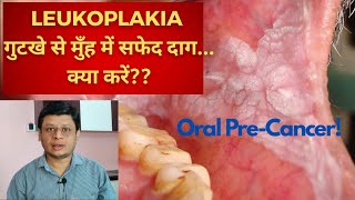 गुटखे से मुँह में सफेद दाग हैं तो क्या ईलाज करेंLeukoplakia in Hindi treatment of Oral PreCancer [upl. by Bronnie]