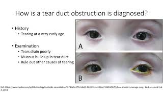 AAPOS Nasolacrimal Duct Obstruction [upl. by Natsirhc372]