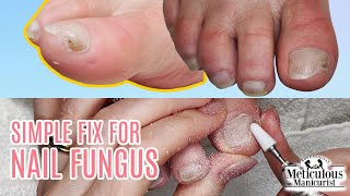 Fix amp Cure Minor Toenail Fungus with Pedicure Care [upl. by Naiditch]