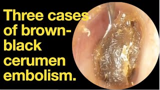 Three cases of brownblack cerumen embolismear wax removal  ear cleaning  ASMR  relaxation [upl. by Lseil]