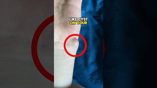 Remove This Dangerous Cyst At Home 😨 viral [upl. by Raviv]