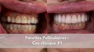 Facettes pelliculaires  Cas clinique 1 [upl. by Courtenay]