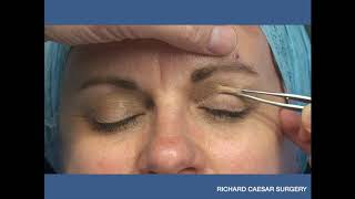 Tutorial  Marking the Upper Lid Blepharoplasty [upl. by Airogerg]